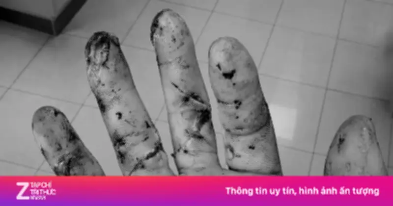 Chàng trai ở TP.HCM bị đứt lìa 3 ngón tay vì máy cưa, cứu sống sau 10 giờ vi phẫu