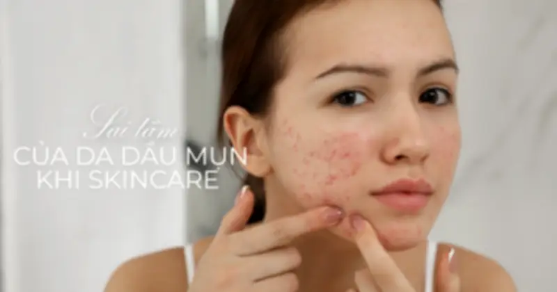 Da dầu mụn có cần dưỡng ẩm mùa nắng nóng? Chuyên gia giải đáp