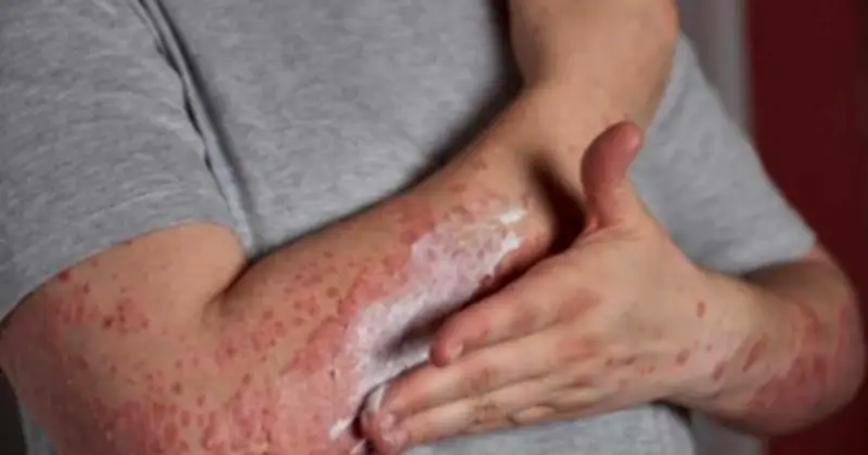 Gia tăng bệnh da liễu mùa mưa ẩm và hệ lụy từ thói quen tự điều trị
