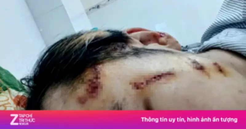 Nam shipper bị đánh nứt sọ vì mâu thuẫn đổi trả hàng 2,3 triệu đồng