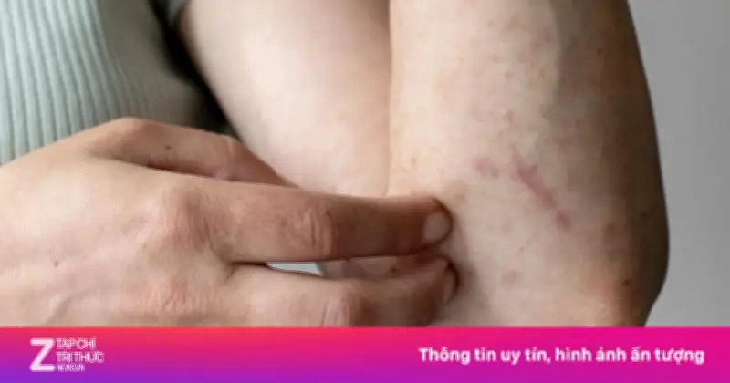 Ngứa hậu môn về đêm: Dấu hiệu cảnh báo nhiễm giun cần xổ ngay
