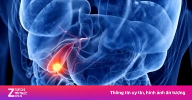 Người đàn ông ăn ngon ngủ tốt bất ngờ phát hiện ung thư túi mật giai đoạn cuối