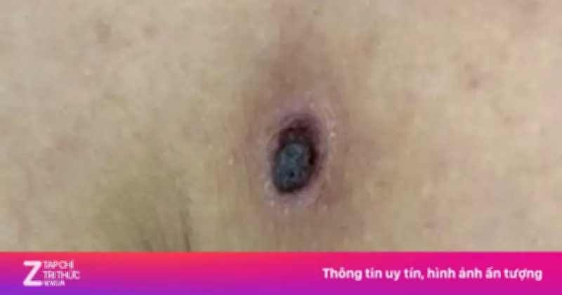 Người phụ nữ 49 tuổi nguy kịch vì sốt mò sau vết đốt không đau