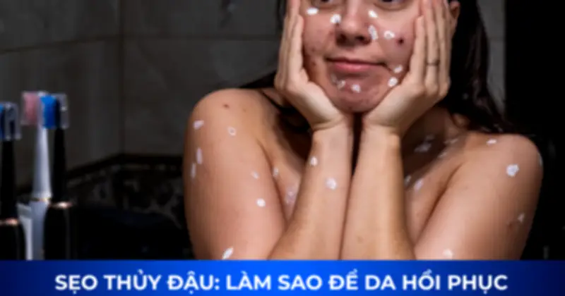 Sẹo thủy đậu có tự hết không? Bí quyết mờ sẹo sau 4 tuần kể cả lâu năm