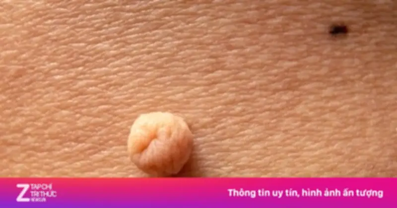 Tự ý nặn nốt sùi mào gà, người đàn ông phải cắt bỏ 103 tổn thương