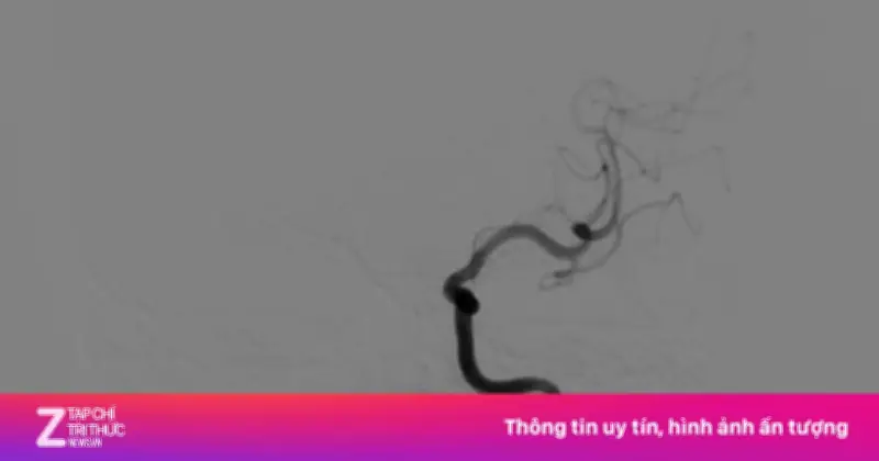 Đột quỵ ở tuổi 33 sau cú bóng đập vào cổ: Cảnh báo bóc tách động mạch cảnh