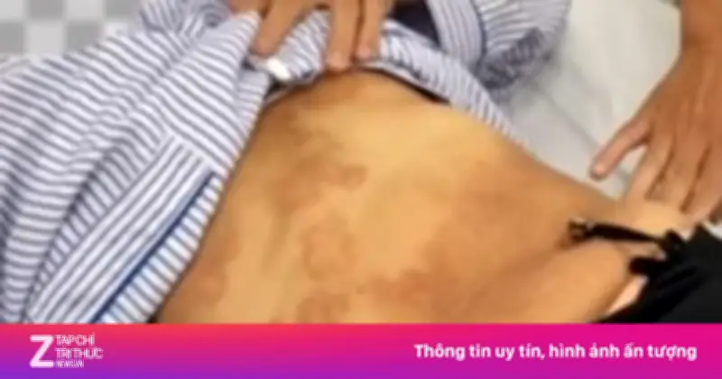 Tự uống 80 viên thuốc tẩy giun, người phụ nữ nhập viện vì nhiễm 5 loại ký sinh trùng