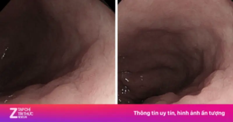 Ung thư đại trực tràng trẻ hóa: 1/4 bệnh nhân dưới 45 tuổi, chuyên gia kêu gọi hạ độ tuổi tầm soát