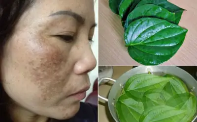 4 cách trị nám lâu năm từ thiên nhiên rẻ tiền nhưng cực nhạy