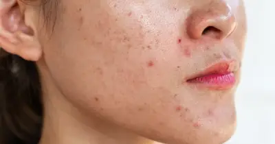 Da dầu mụn mãi không hết? Sai lầm phổ biến khiến mụn tái phát