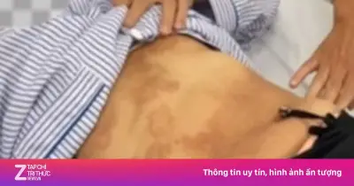 Tự uống 80 viên thuốc tẩy giun, người phụ nữ nhập viện vì nhiễm 5 loại ký sinh trùng