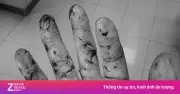 Chàng trai ở TP.HCM bị đứt lìa 3 ngón tay vì máy cưa, cứu sống sau 10 giờ vi phẫu