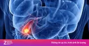 Người đàn ông ăn ngon ngủ tốt bất ngờ phát hiện ung thư túi mật giai đoạn cuối